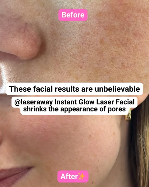 Split screen close-up of cheek skin before and after LaserAway Instant Glow Laser Facial showing smaller looking pores