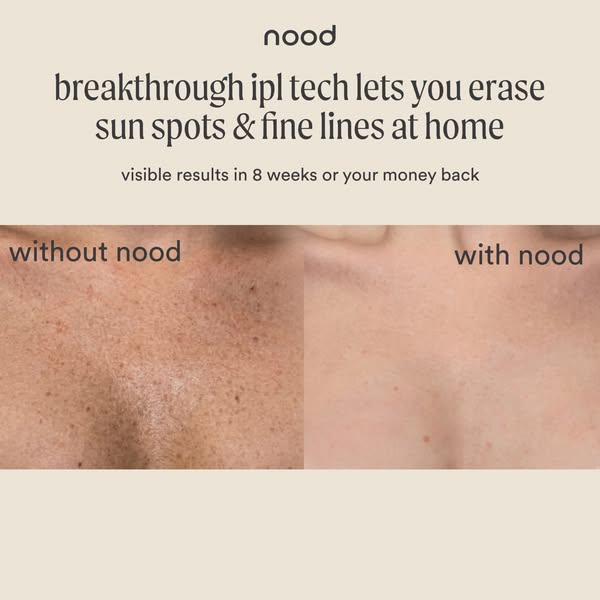 Side by side chest close-ups, sun-spotted skin labelled without nood and clear skin labelled with nood, under a headline