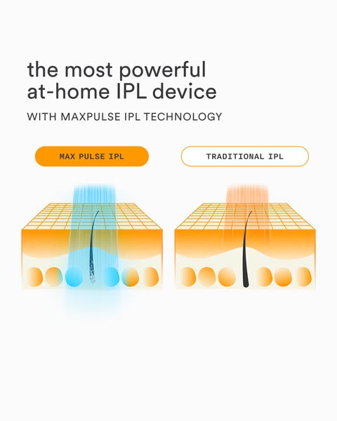 Skin cross-sections comparing a deep blue MaxPulse IPL beam reaching the follicle with a shallow traditional IPL beam